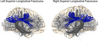 Segmental abnormalities of superior longitudinal fasciculus microstructure in patients with schizophrenia, bipolar disorder, and attention-deficit/hyperactivity disorder: An automated fiber quantification tractography study